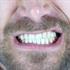 دندان قروچه چیست و علل و نحوه درمان آن